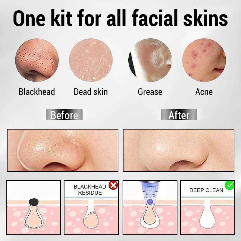 Electric Blackhead Remover — Deep Pore Vacuum Cleanser | Clearer, Smoother Skin